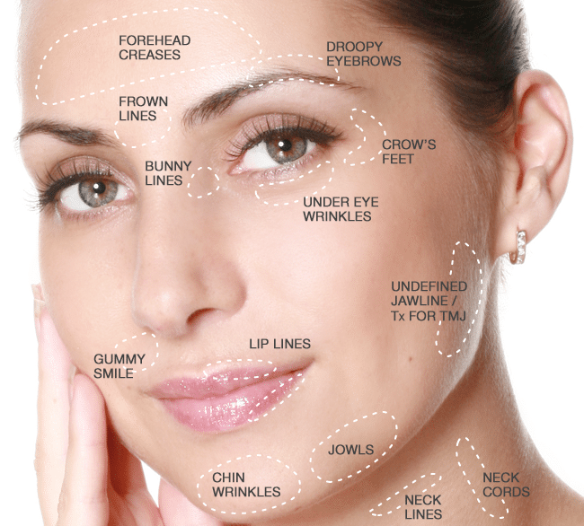 Apologise, facial procedures to correct crows feet opinion you Apologise, facial procedures to correct crows feet can