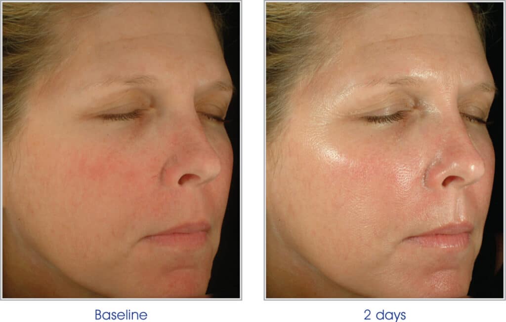 Side by side before and after close up of woman's face while she closes her eyes, showing improvements from blue peel facial treatment