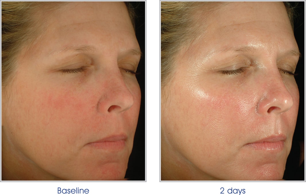 female patient's face before and 2 days after facial peel