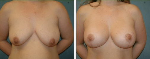 Breast Lift with Breast Augmentation