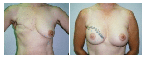 Breast Reconstruction