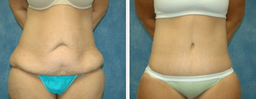 Tummy Tuck Before and After Photos