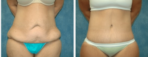 Oregon Plastic Surgeons  Having a Tummy Tuck After Weight Loss