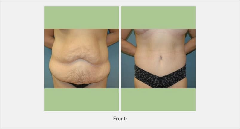 Abdominoplasty