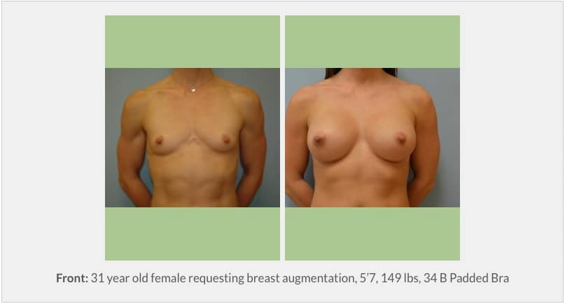 two before and after photos of a woman's chest before and after receiving breast implants, with text describing the photos on the bottom