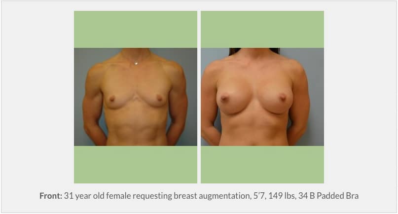 Breast Augmentation Surgery