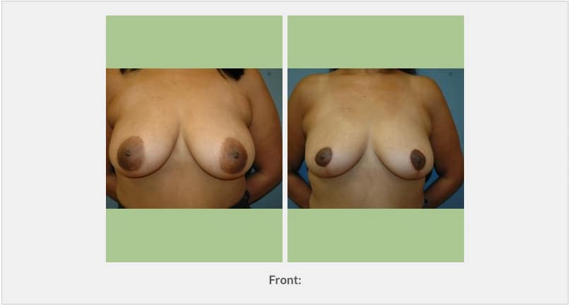 Breast Lift