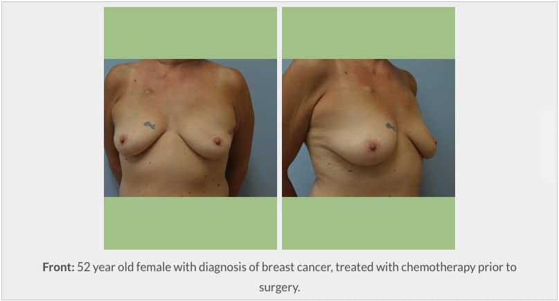 Breast Reconstruction