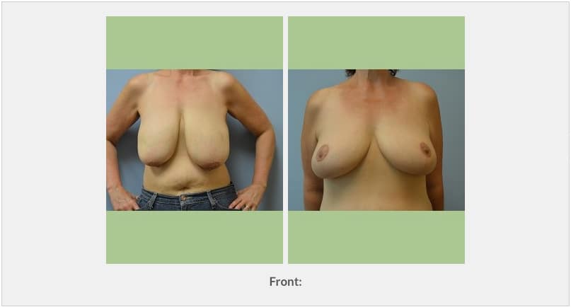 woman before and after breast reduction, with smaller, perkier breasts after procedure