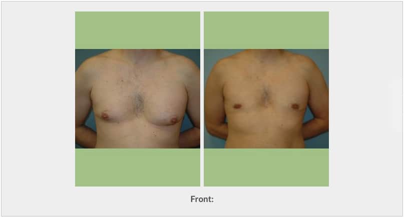 Gynecomastia