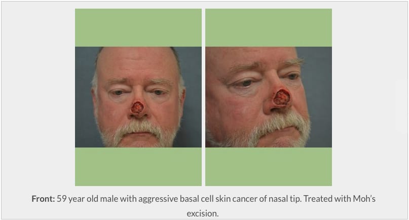 Photo of 59 year old male with aggressive basal cell skin cancer of nasal tip