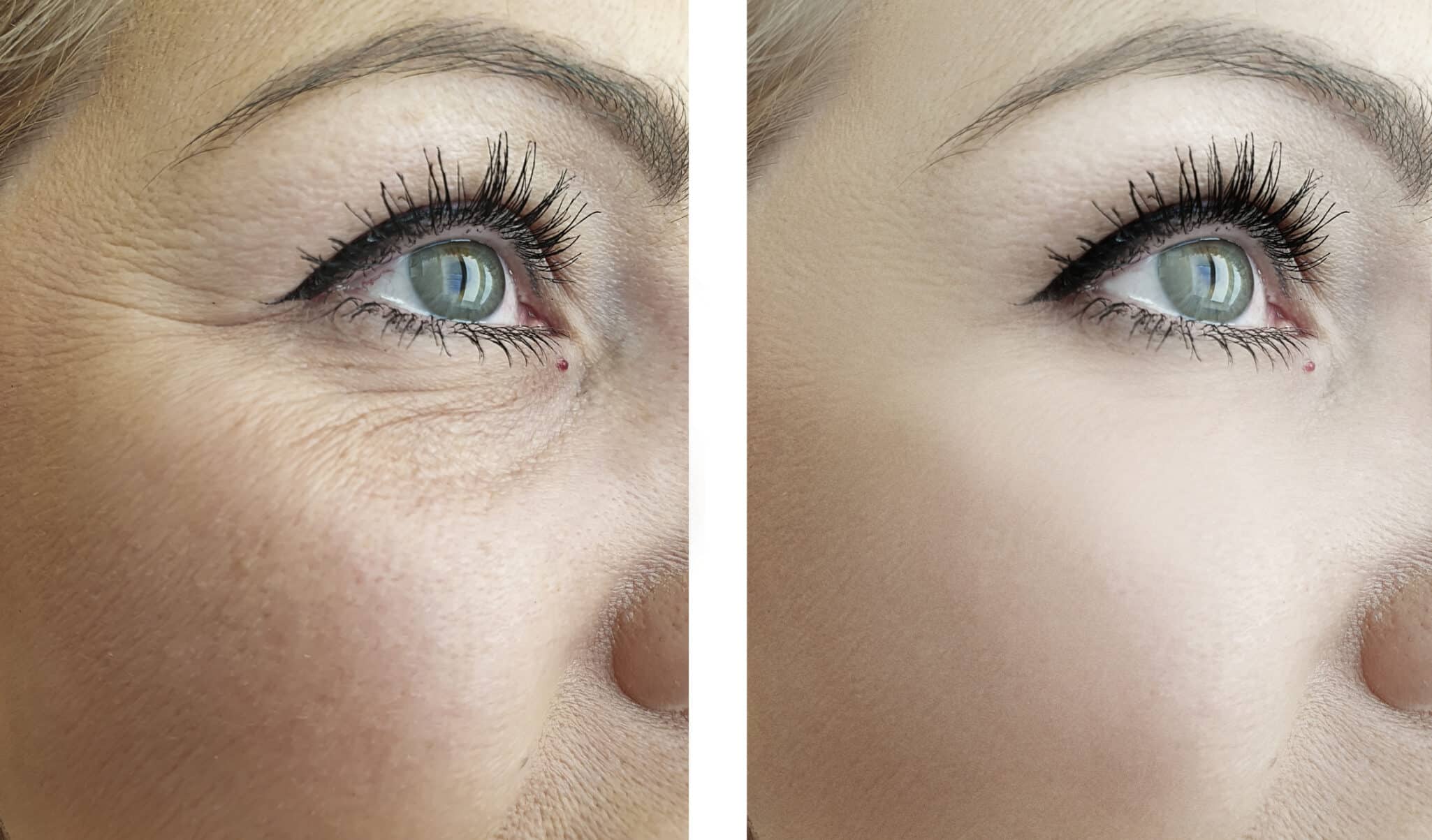 woman eye wrinkles before and after procedures