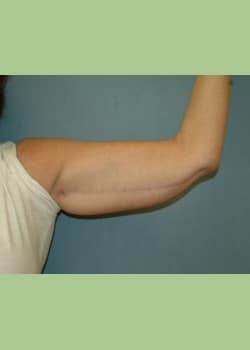 patient’s arm after brachioplasty arm lift, less hanging skin after procedure