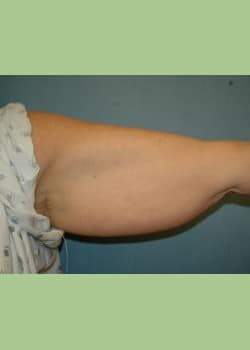 patient’s arm with hanging skin before brachioplasty arm lift procedure