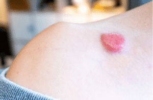 Raised dermatfibrosarcoma protuberans (DFSP, non-melanoma skin cancer) on chest shoulder having formed red pigment and spider veins, removable by mohs surgery