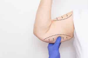 Doctor holds the hand of a female patient on a white background. The concept of skin tightening on the hand and fat removal, plastic surgery, markers, copy space, brachioplasty