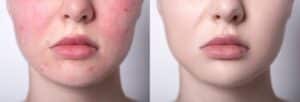 Before and after photo of woman with rosacea shows how IPL treatment can reduce redness and give skin an attractive texture