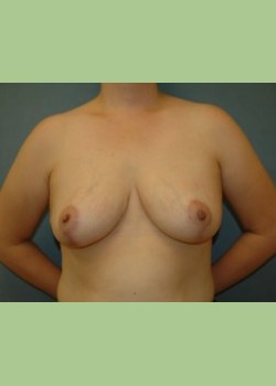 Breast Reduction