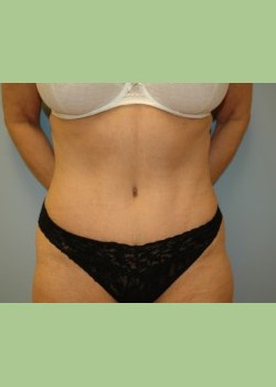 Abdominoplasty