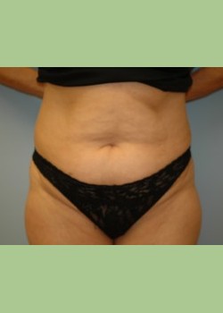 Abdominoplasty