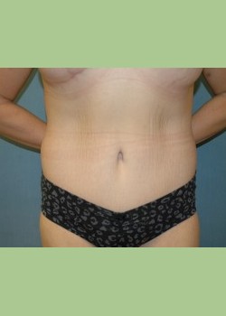 Abdominoplasty