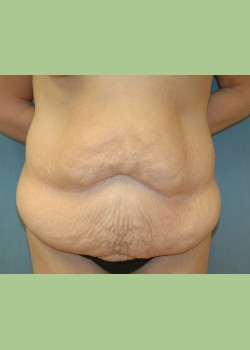 Abdominoplasty