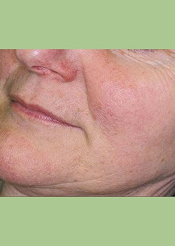 Rosacea Treatment