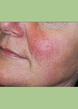 Rosacea Treatment