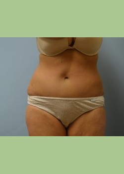 Abdominoplasty