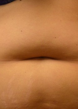 Abdominoplasty