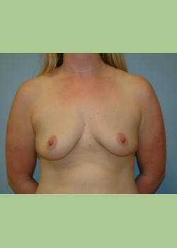 Breast Augmentation