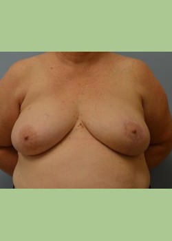 Left Breast Reduction