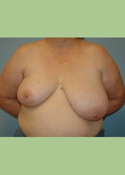 Left Breast Reduction