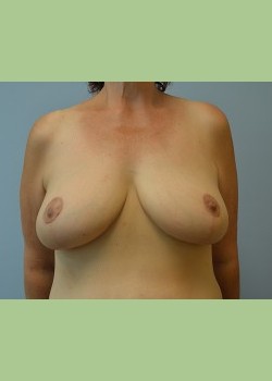 Breast Reduction with Wise Pattern Mastopexy
