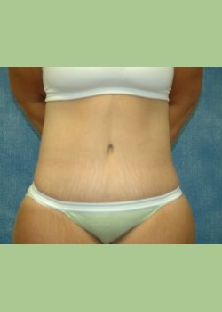 Abdominoplasty