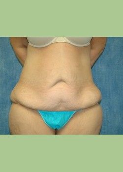 Abdominoplasty